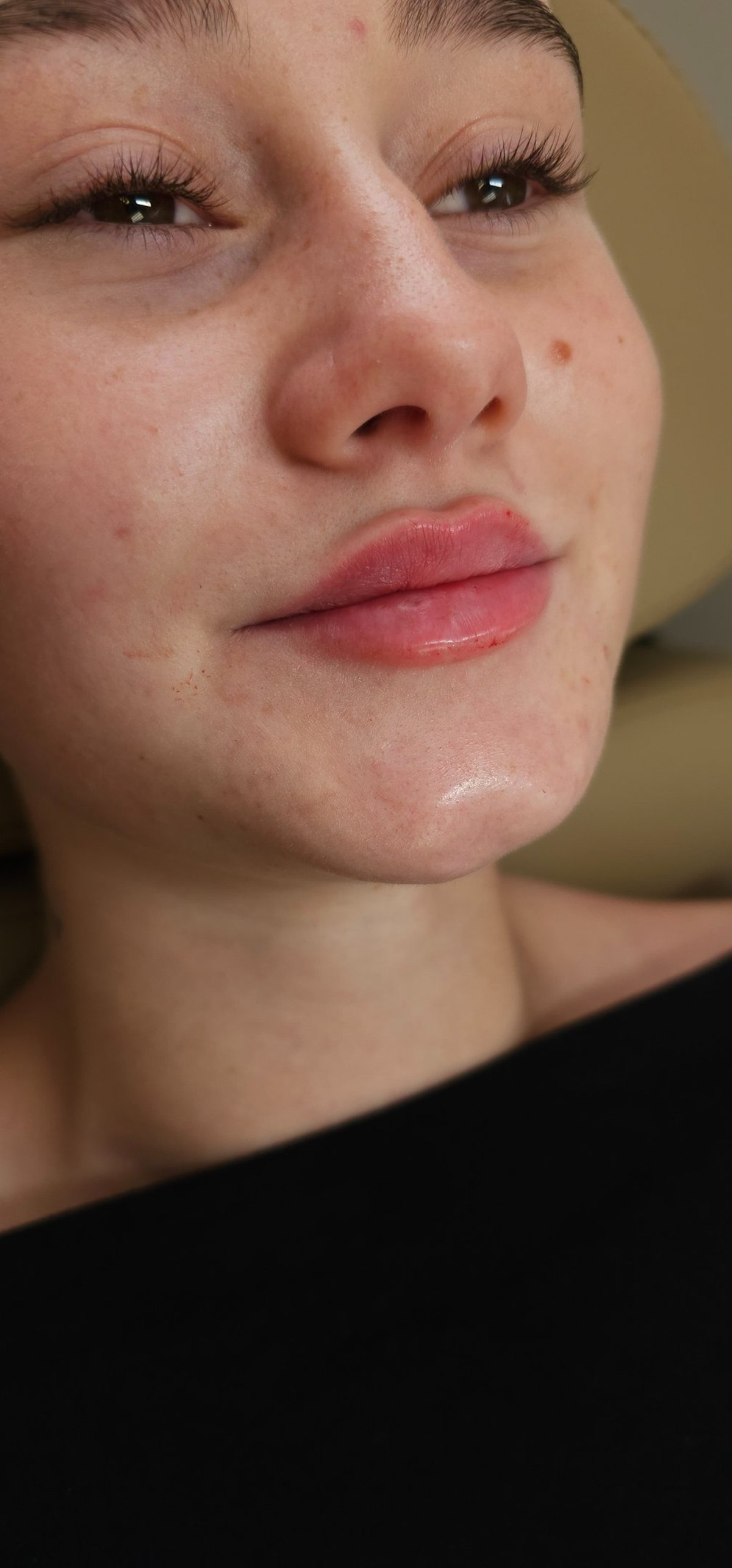 Lip enhancement before and after by Little Red Esthetics