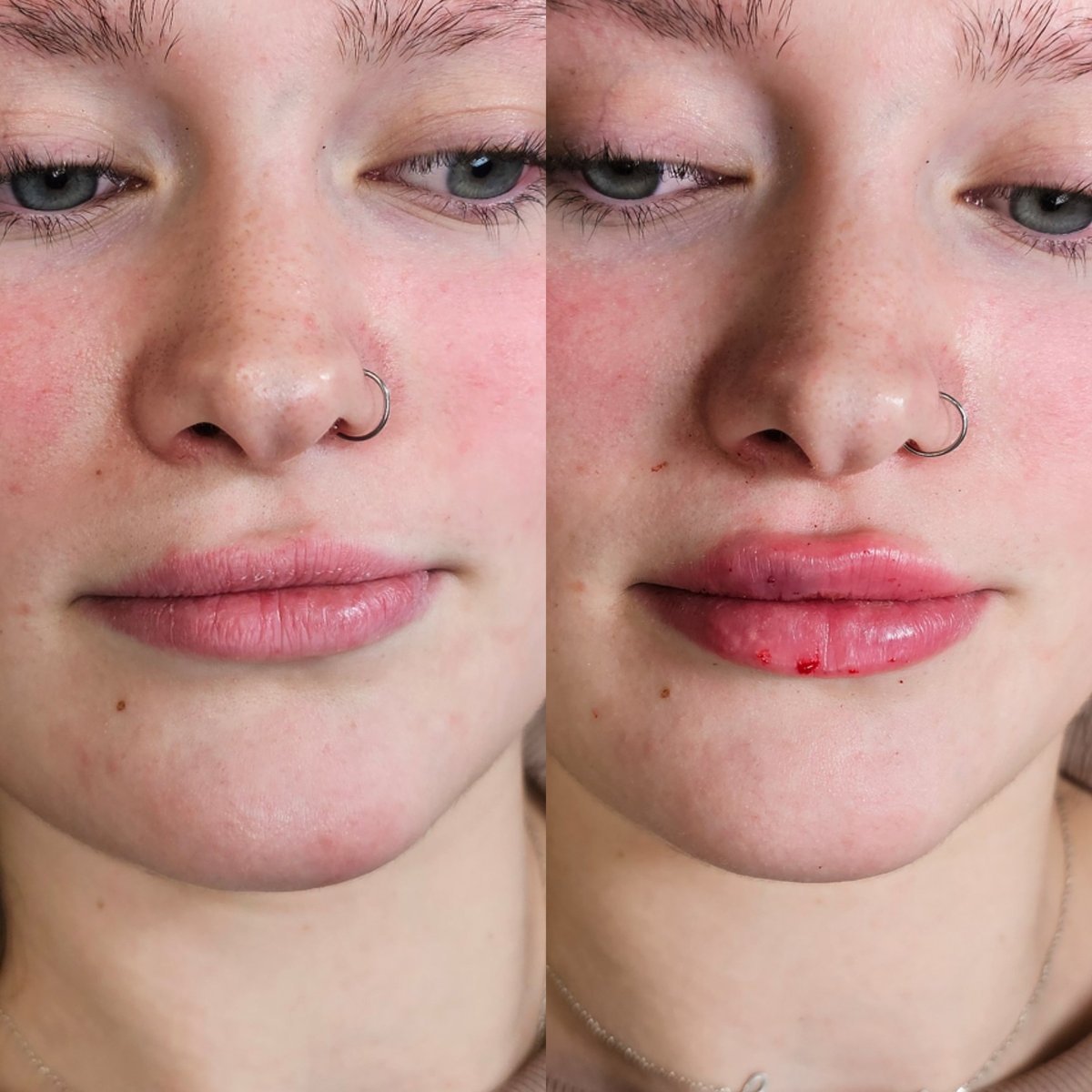 Dermal filler results by Little Red Esthetics